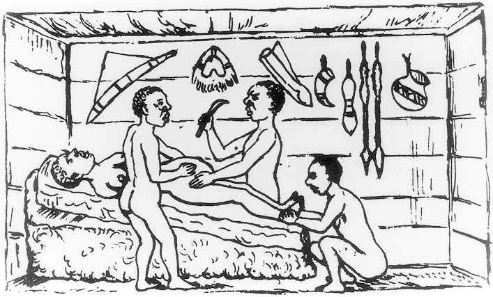 An ancient drawing of Caesarean birth being carried out